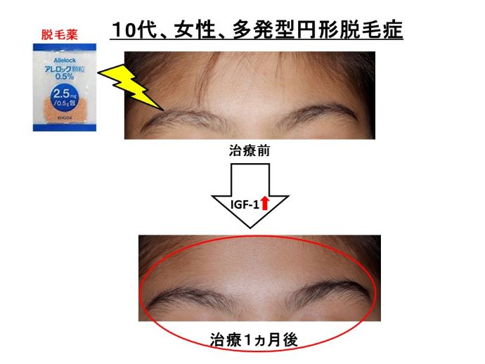 円形脱毛症　病院